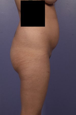 Brazilian Butt Lift